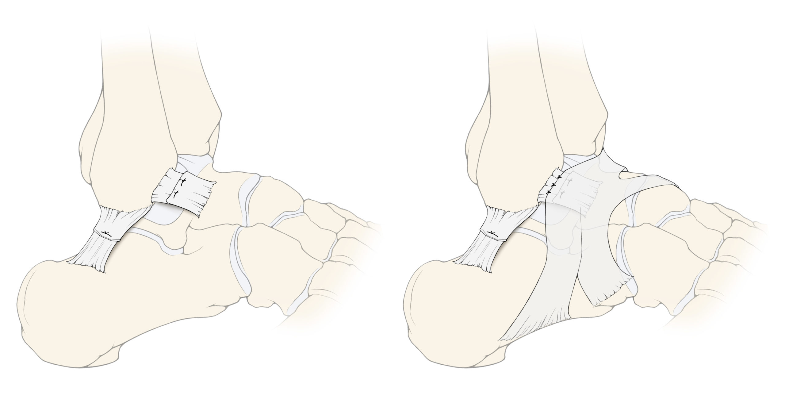 OSGInstabilität Der Fußspezialist